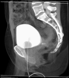 Cystogram - CTisus CT Scan