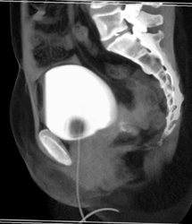 Cystogram With Fistulae to Vagina - CTisus CT Scan