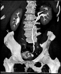 Bladder Cancer With Duplication in Left Collecting System - CTisus CT Scan