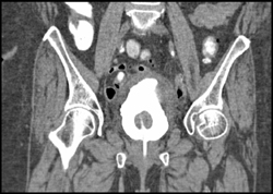 Pre-vesicle Hematoma - CTisus CT Scan