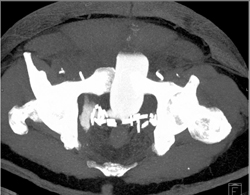 Leak at Prostatectomy Site - CTisus CT Scan