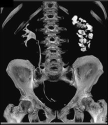 Dilated S/P Calyces in the Left Kidney - CTisus CT Scan