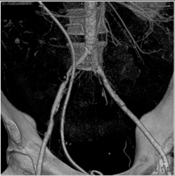 Retroperitoneal Fibrosis Encases the Right Internal Iliac Artery - CTisus CT Scan