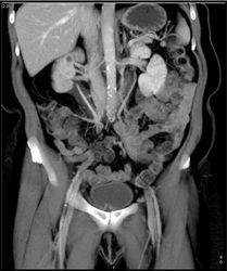 Retroperitoneal Fibrosis - CTisus CT Scan