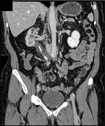 Retroperitoneal Fibrosis - CTisus CT Scan