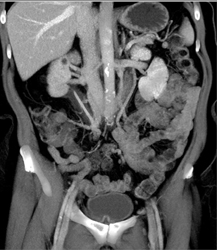 Retroperitoneal Fibrosis - CTisus CT Scan