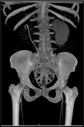 Retroperitoneal Fibrosis - CTisus CT Scan