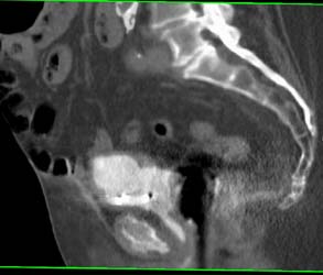 Artifact Off Bilateral Total Hip Replacement (THR) - CTisus CT Scan