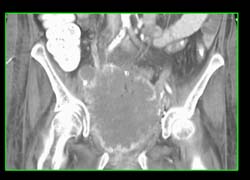 Aggressive Bladder Cancer That Is Locally Invasive - CTisus CT Scan