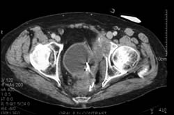 Bladder Cancer Invades Pelvic Side Wall - CTisus CT Scan