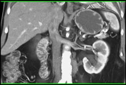 Retroperitoneal Fibrosis Encases the Left Ureter - CTisus CT Scan