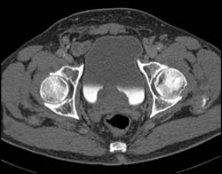 Bladder Compression By Prostate S/P Transurethral Resection of the Prostate (TURP) - CTisus CT Scan