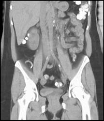 Bladder Cancer With Several Different Phases - CTisus CT Scan