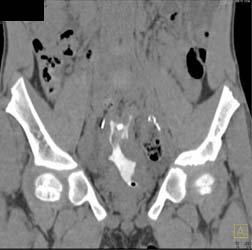 Leak From Bladder - CTisus CT Scan