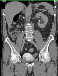 Bladder Cancer - CTisus CT Scan