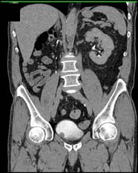 Bladder Cancer - CTisus CT Scan