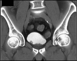 Bladder Cancer - CTisus CT Scan