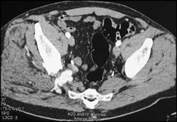 Arteriovenous Malformation (AVM) Near Right Sciatic Notch - CTisus CT Scan