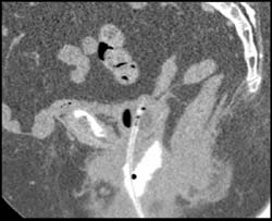 Vesicovaginal Fistulae - CTisus CT Scan