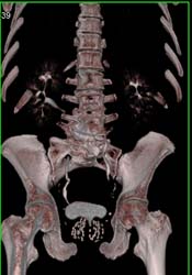 Radium Seeds in the Prostate - CTisus CT Scan