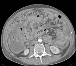 Bladder Cancer With Carcinomatosis - CTisus CT Scan