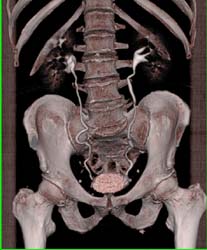 Ct Urogram - CTisus CT Scan