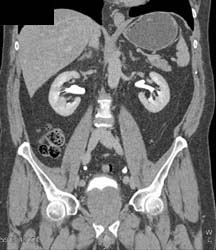 Ct Urogram and Huge Prostate - CTisus CT Scan