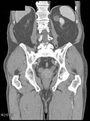 Bladder Cancer - CTisus CT Scan