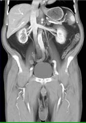 Bladder Cancer - CTisus CT Scan