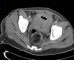 Bladder Cancer - CTisus CT Scan