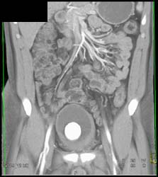 Calcification of Suprapubic Catheter - CTisus CT Scan