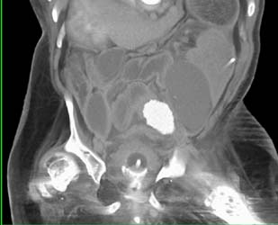 Pelvic Abscesses - CTisus CT Scan