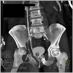 Pelvic Resection With CT Urogram - CTisus CT Scan