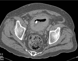 Bladder Cancer - CTisus CT Scan