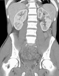 Acute Pyelonephritis - CTisus CT Scan