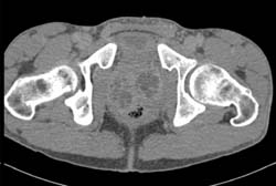 Tuberculosis (TB) of the Prostate - CTisus CT Scan