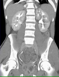 Acute Pyelonephritis - CTisus CT Scan