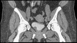 Bladder Cancer - CTisus CT Scan