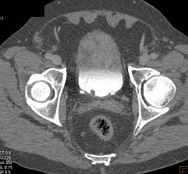 Bladder Cancer - CTisus CT Scan