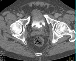 Bladder Cancer - CTisus CT Scan