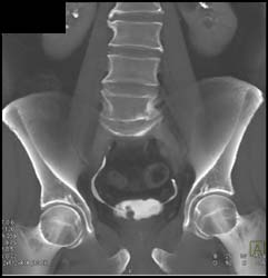 Bladder Cancer - CTisus CT Scan