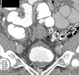 Bladder Cancer - CTisus CT Scan