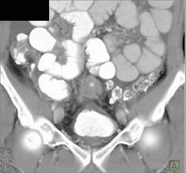 Bladder Cancer - CTisus CT Scan