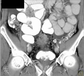 Bladder Cancer - CTisus CT Scan