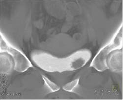 Bladder Cancer - CTisus CT Scan