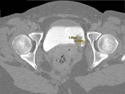 Bladder Cancer - CTisus CT Scan