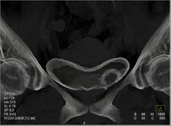 Bladder Cancer - CTisus CT Scan