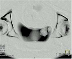 Bladder Cancer - CTisus CT Scan