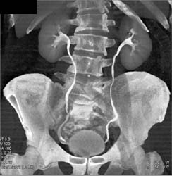 Bladder Cancer - CTisus CT Scan