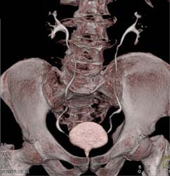 S/P Transurethral Resection of the Prostate (TURP) - CTisus CT Scan